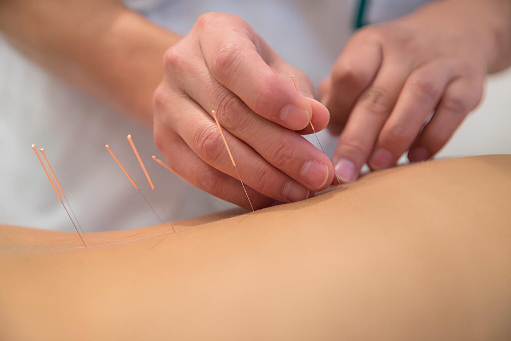 Acupuncture