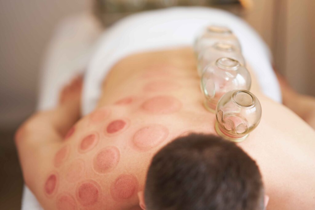 Cupping Therapy