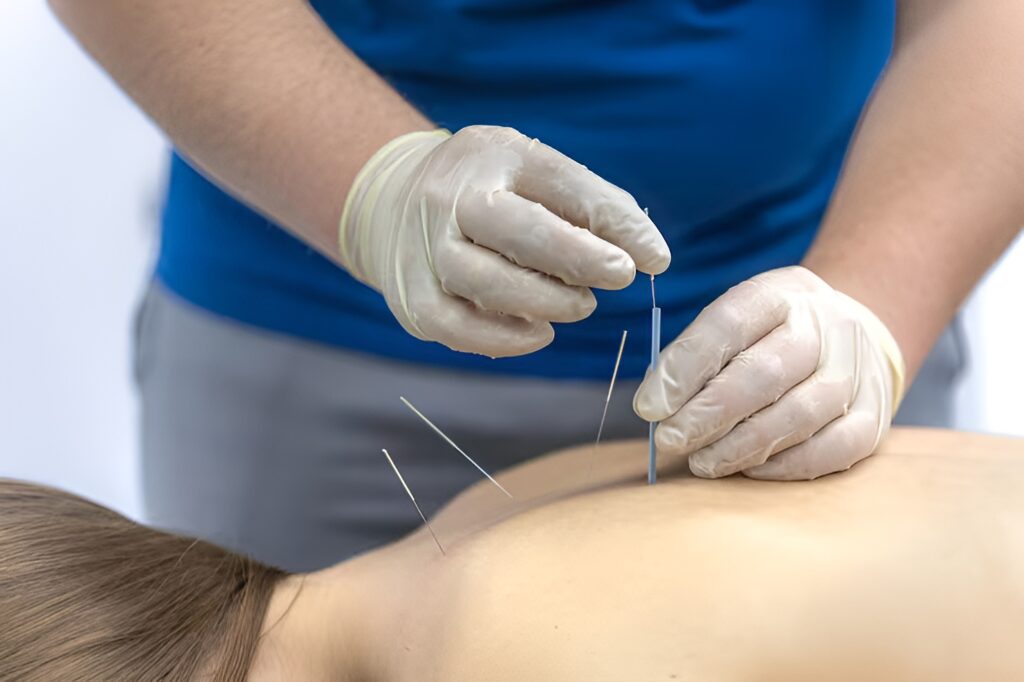 Dry Needling